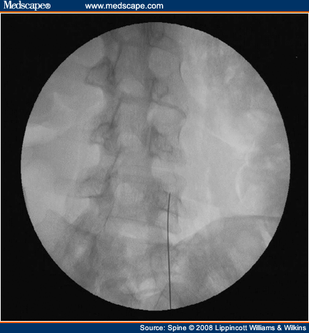 Percutaneous Lumbar Zygapophysial Joint Neurotomy Using Radiofrequency