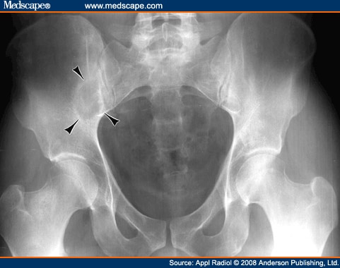 Radiological Case: Ewing's Sarcoma