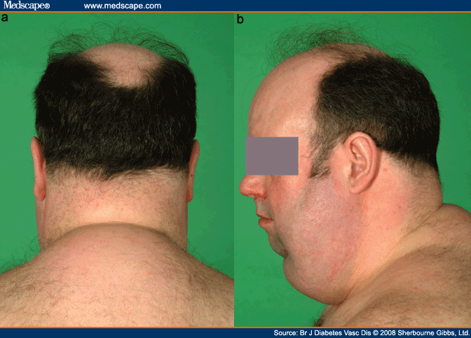 A Drug for Neck Fat, and Some Thoughts on Fat Accumulation Syndromes in ...