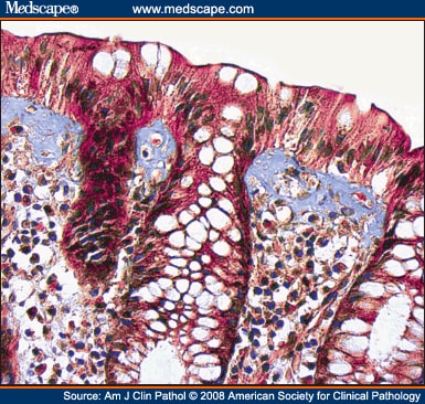 Subepithelial Collagen Band Does Not Increase the Accuracy of Diagnosis of