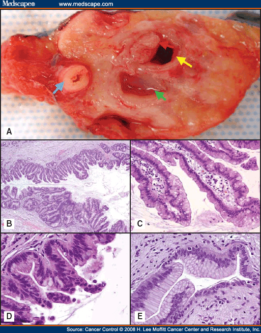 Management of an Intraductal Papillary Mucinous Neoplasm of the Pancreas