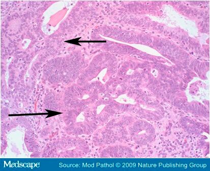 Endometrial Adenocarcinoma in Situ in Complex Atypical Endometrial