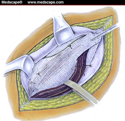 Surgery Roundtable: Current Issues in Inguinal Herniorrhaphy