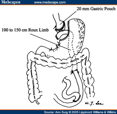 Laparoscopic Roux-en-Y Versus Mini-Gastric Bypass for the Treatment of ...