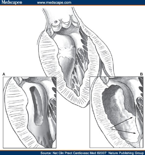 Septal Myectomy for Obstructive Hypertrophic Cardiomyopathy -- Mayo ...