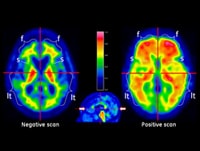 FDA Approves Third Amyloid PET Tracer for Alzheimer's