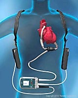 LVAD Thrombosis Rates: Did Pump Therapy Suffer From Success?