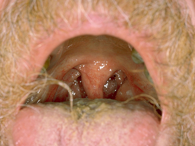 tonsil cancer hpv