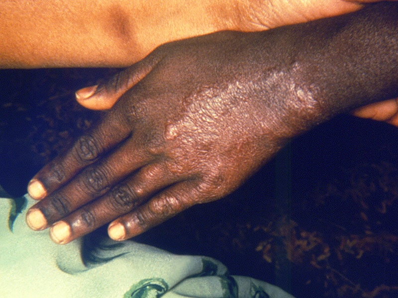 cdc travel advisory leprosy