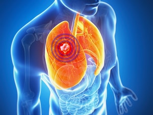 Finally, RCT Results for Proton Therapy in a Cancer