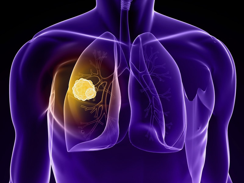 New EGFR Inhibitor Overcomes Resistance in NSCLC