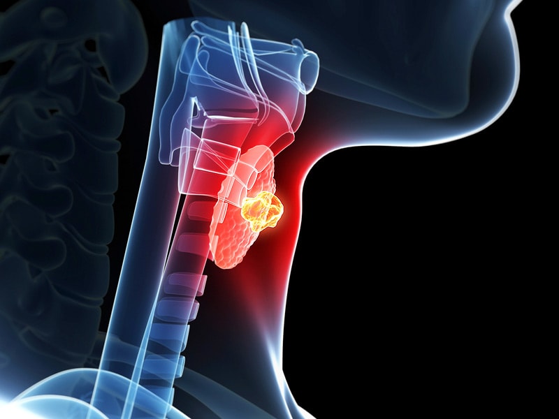 Thyroid Cancer Increase Is It Real?