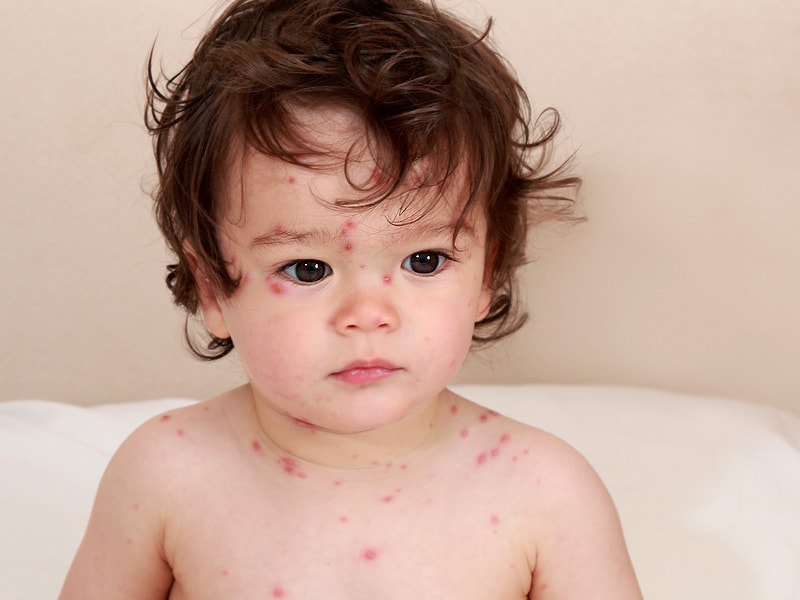 Varicella Vaccine Reduces Incidence; No Shift to Older Kids