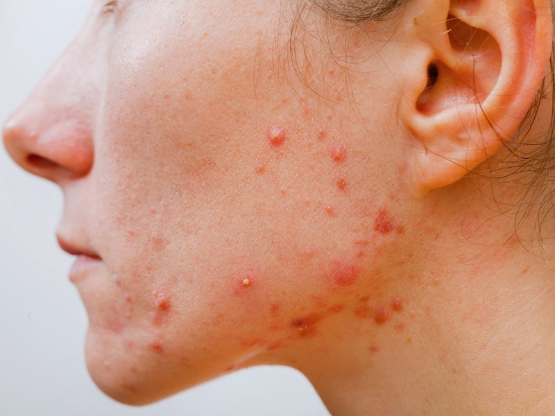 Serious Allergic Reactions Possible With Acne Products