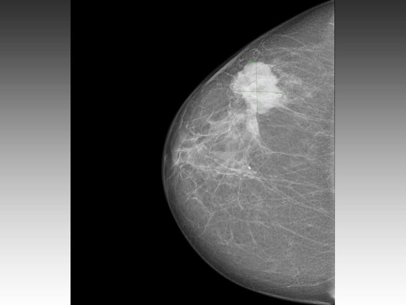Новообразование в груди у женщин. Фиброзно кистозная мастопатия маммограмма. Маммография фиброаденома. Фиброаденома молочной на маммографии. Фиброаденома молочной железы рентген.