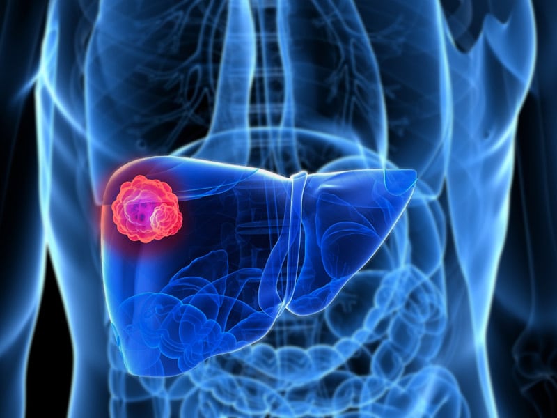 High Survival Rate With Tumor Downstaging Before Transplant