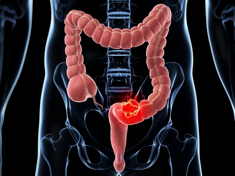 Colorectal Cancers on the Rise in Younger Adults