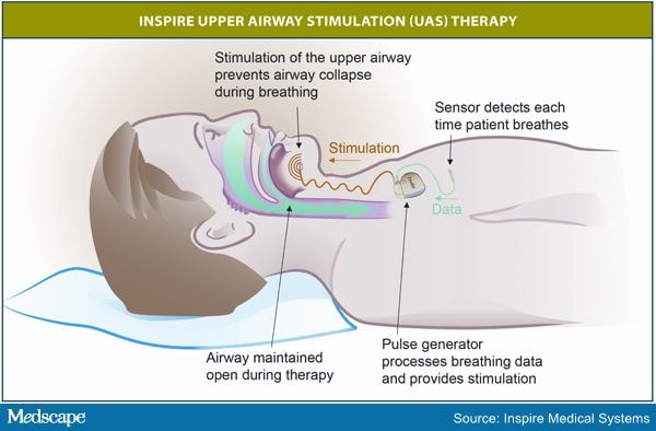 Nerve Stimulation Promising Approach in Sleep Apnea