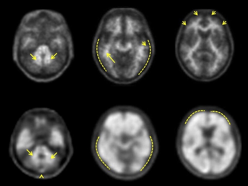 FDA Approves Third Amyloid PET Tracer for Alzheimer's