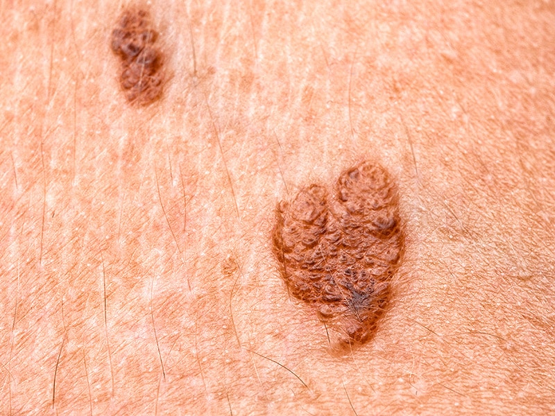 Melanoma, Parkinson's: See One, Be Aware of the Other