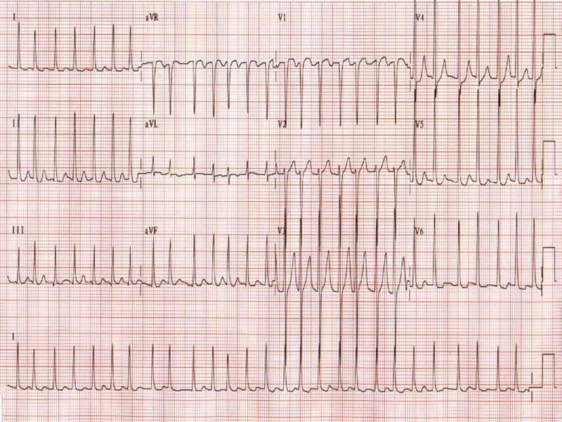 new onset atrial flutter icd 10
