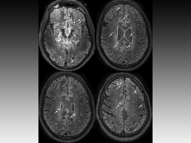 fingolimod-trial-in-progressive-ms-misses-endpoint