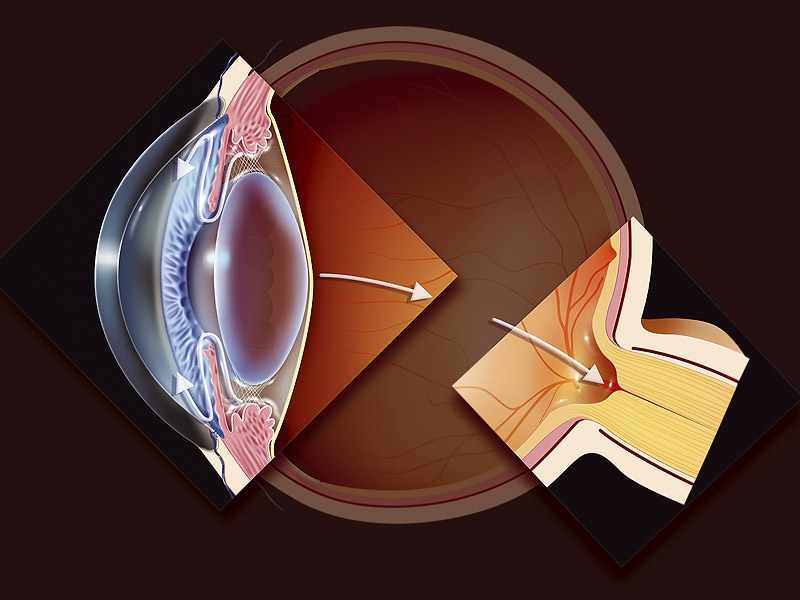 glaucoma angle open laser iop stent surgery treatment stents micropulse cataract prostaglandin ps medscape