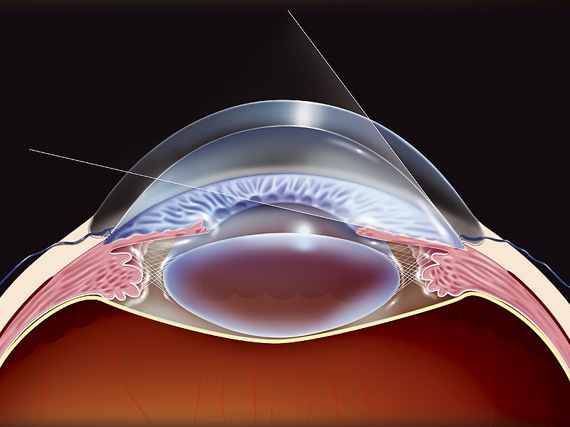 Глазные клиники замена хрусталика. Узкоугольная глаукома. Открытоугольная глаукома. Открытоугольная и закрытоугольная глаукома. Кольцевидная глаукома.
