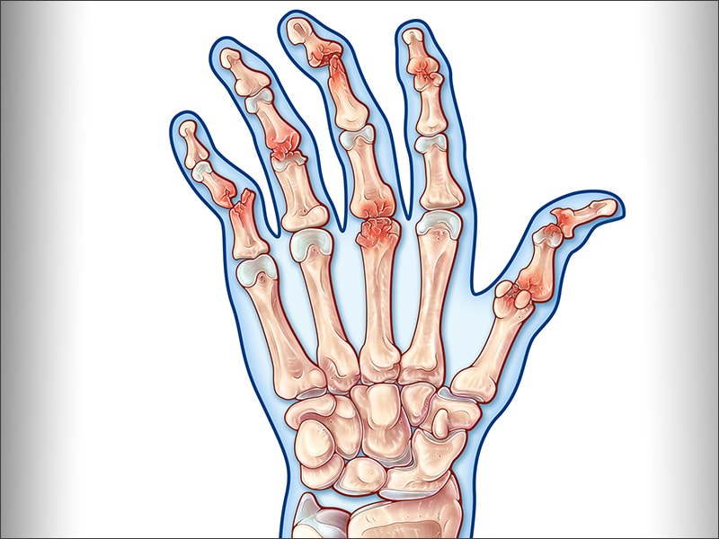How to Reverse Autoimmune Arthritis and Inflammation in Your Hands ...