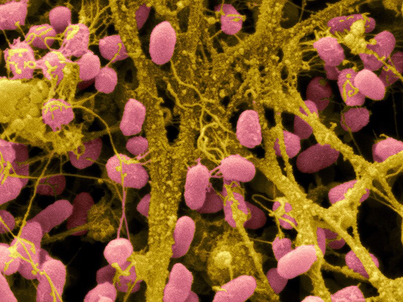 Bacterial Biofilms May Play Role in Colorectal Cancer