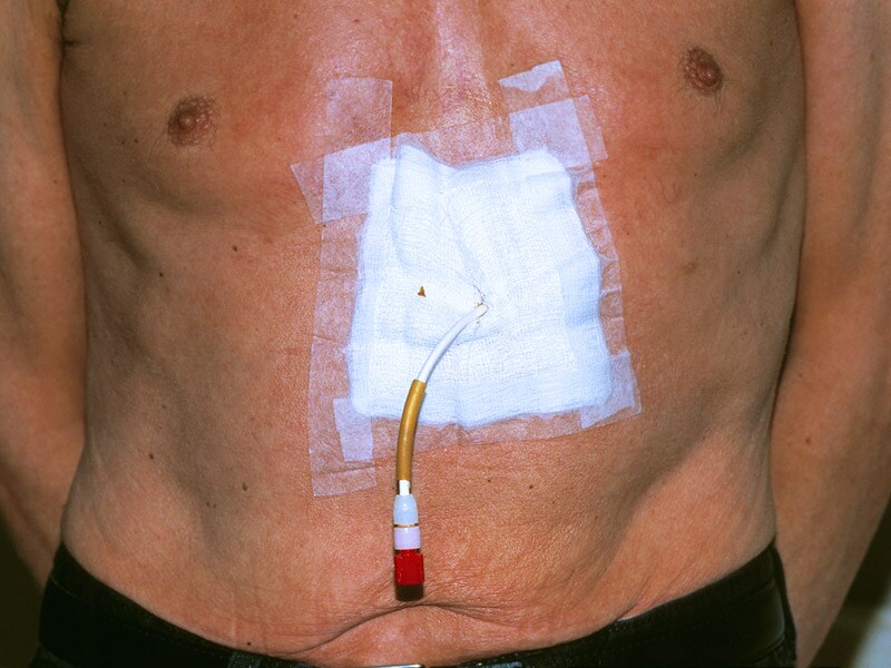 Feeding Tube For Cancer Patients