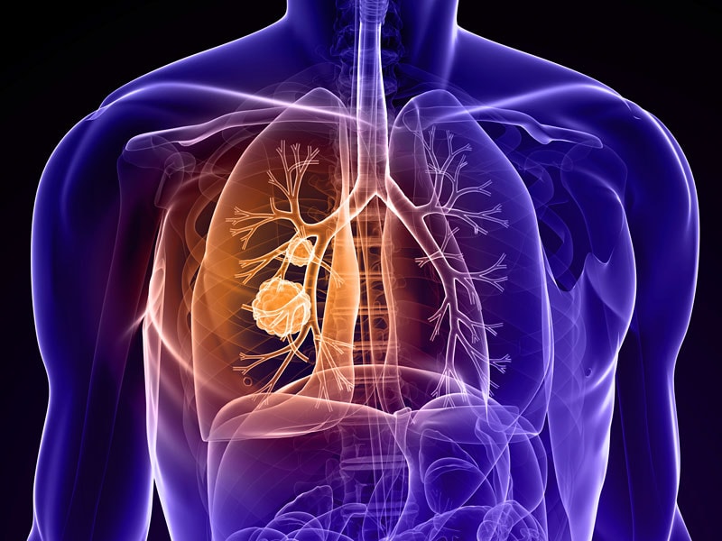 Atezolizumab First-Choice Immunotherapy in Second-Line NSCLC?