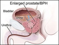 does tamsulosin help with prostatitis