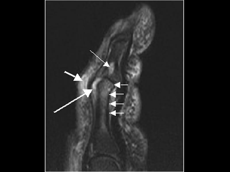 FDA Clears Apremilast Otezla For Psoriatic Arthritis   Wc 140321 Psoriatic Arthritis 800x600 