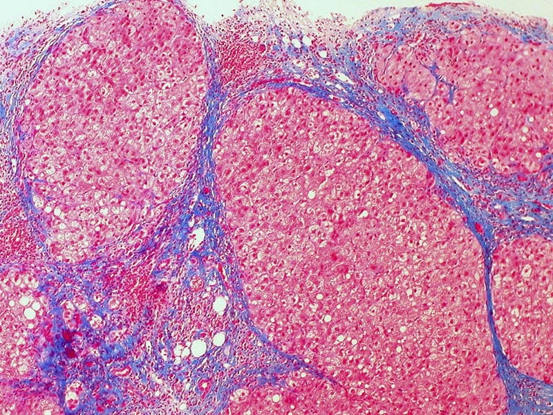 triple-combination-works-in-cirrhotic-hepatitis-c-patients