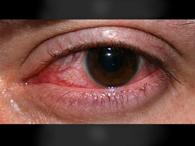 Steroids Early in Bacterial Keratitis May Improve Vision