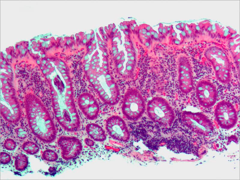 case-of-sessile-serrated-polyp-ssp-with-cytological-dysplasia-in-the