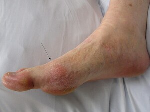 Canakinumab Halves Gout in Patients With Atherosclerosis