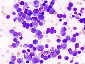 Three-Drug Combo Now Standard in Newly Diagnosed Myeloma