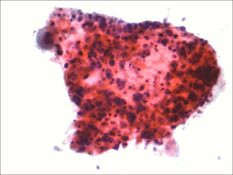 Postop Radiation Improves Prognosis in LaterStage NSCLC