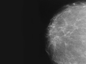 Breast Density Not a Strong Risk Factor for Cancer