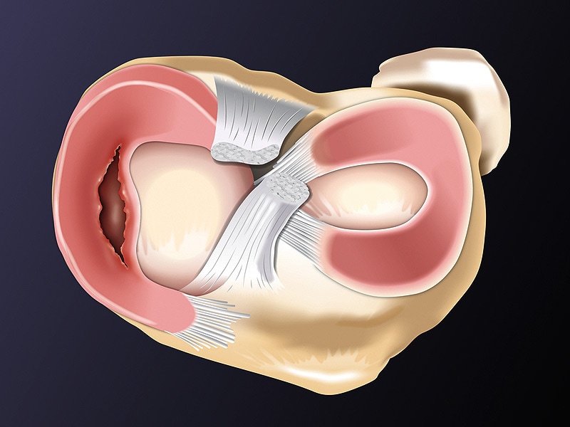 Meniscal Lesions May Help ID Patients With Severe Knee OA