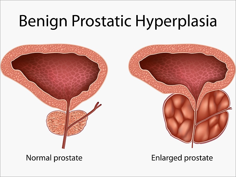enlarged prostate at 24 masaj împotriva prostatitei