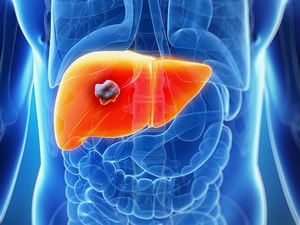 Novel Score Predicts Recurrence of Liver Cancer