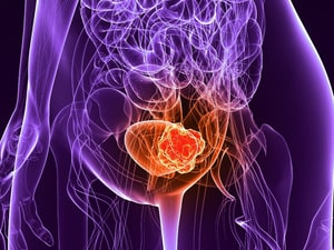 Chemohyperthermia Shows Promise in Nonmuscle Bladder Cancer