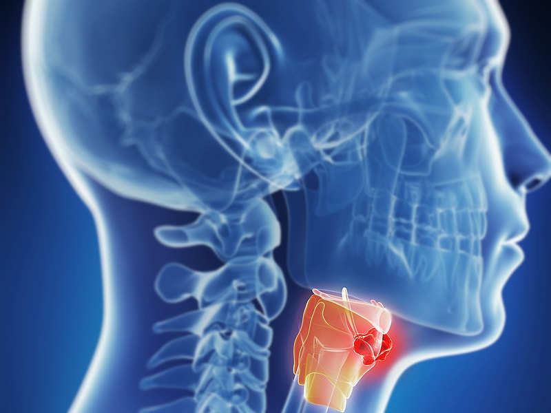 Hpv Throat Cancer In Men Increasing Link To Oral Sex 3777