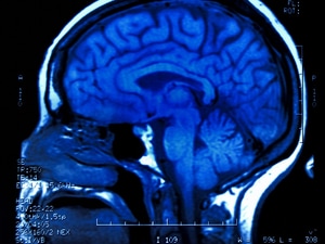 GLP-1 Agonist Alters Brain Response to Seeing,     Eating Food