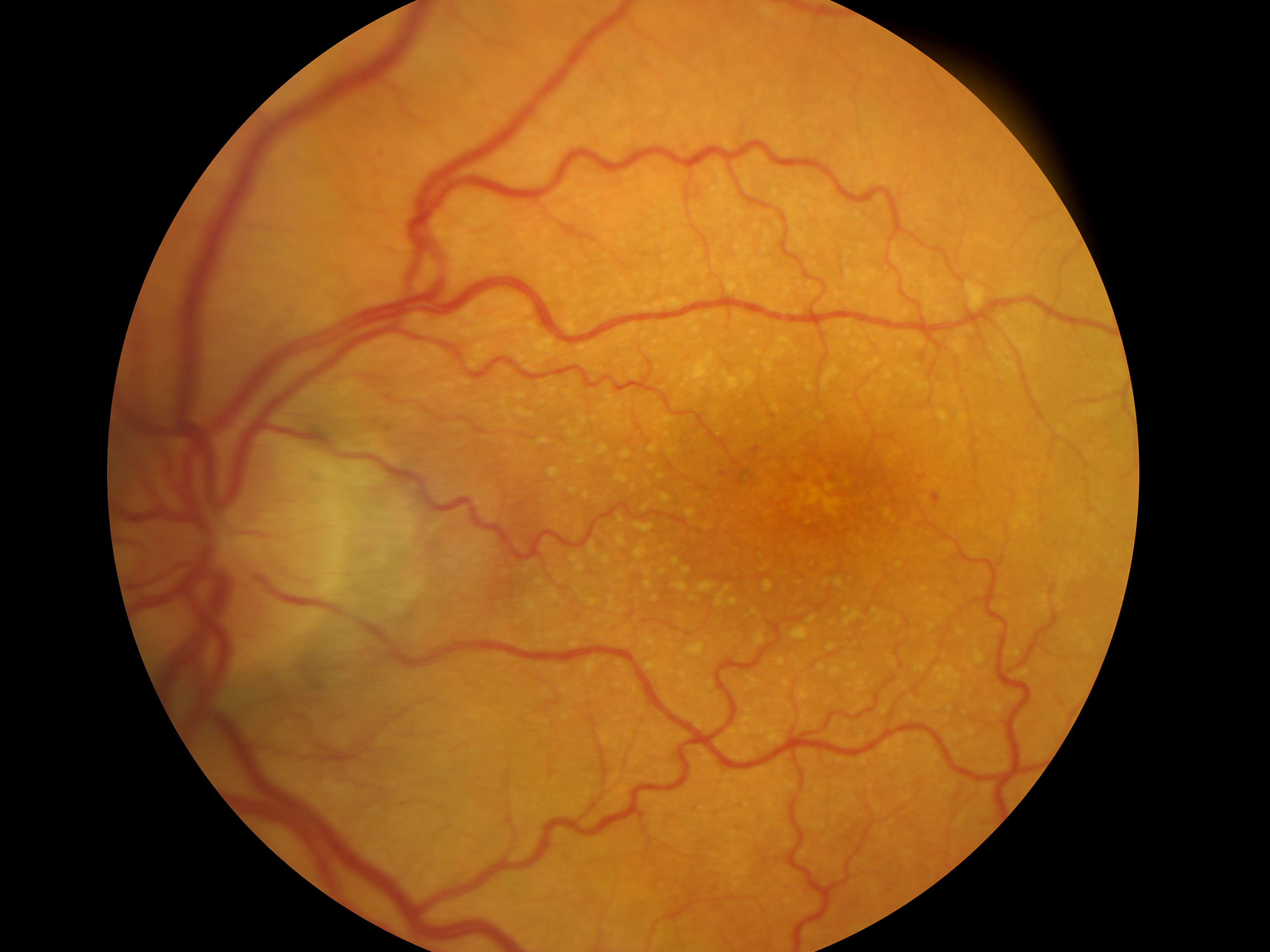 Макулярный отек лечение. Эпиретинальная мембрана сетчатки. Пигментный ретинит сетчатки. Макулярный фиброз сетчатки. Пигментный ретинит глазное дно.