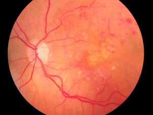 Anti-VEGF Therapy Before Steroids for Retinal Vein Occlusion