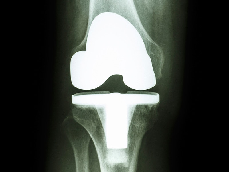 Antibiotic Prophylaxis For Patients With Prosthetic Joints 1483